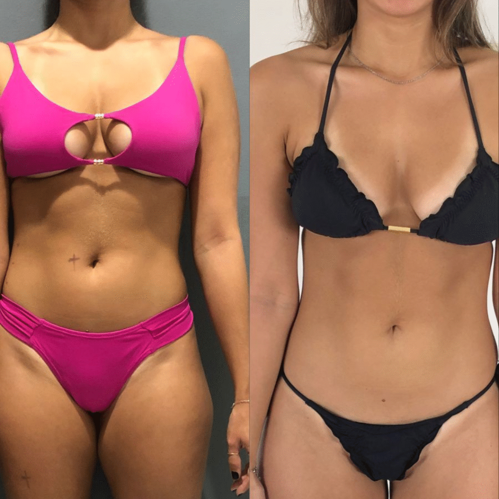 ANTES E DEPOIS BRANDÃO